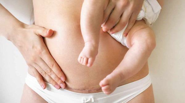 Come posso allattare con successo dopo un parto cesareo?
